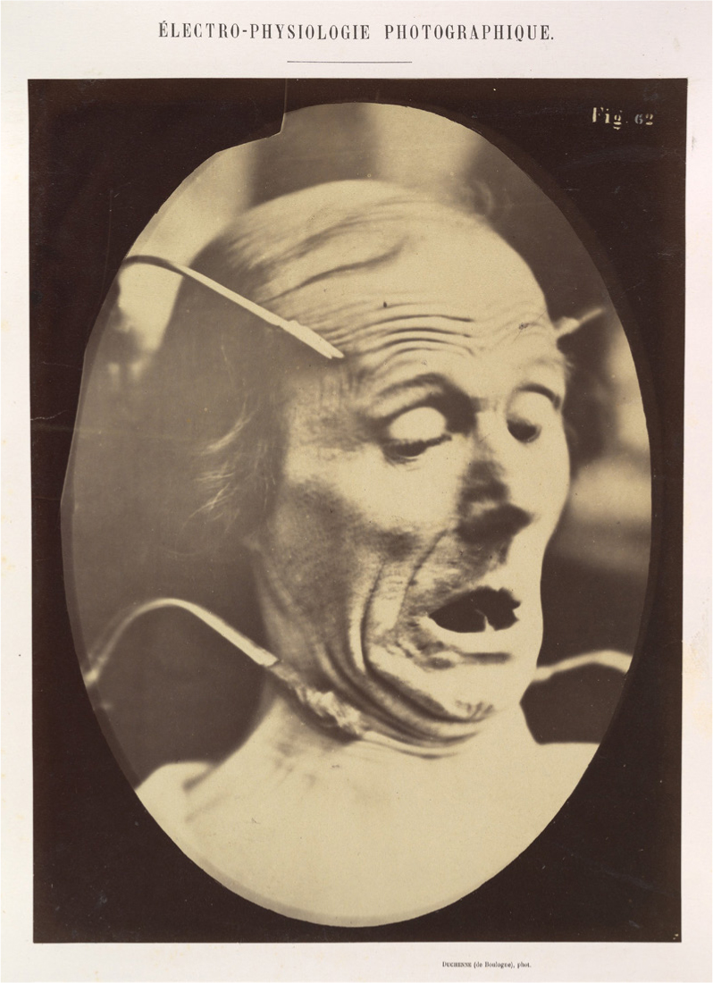 Figure 12. An old man's face. Four electrodes are applied, two near the corners of his eyebrows, two near his jawline. The man's mouth is open.